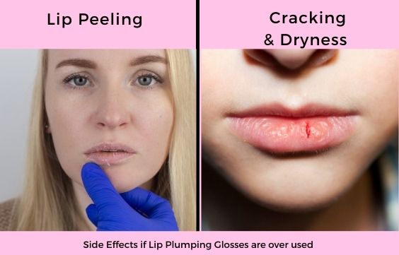 Side effects of lip plumping glosses 